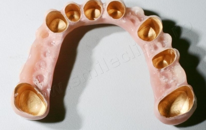 Maxillary dental prosthesis
