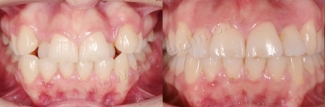 Crossbite bilateral incisors