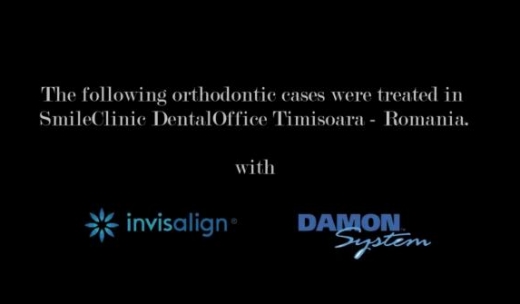Tratamente ortodontice cu Invisalign si Damon